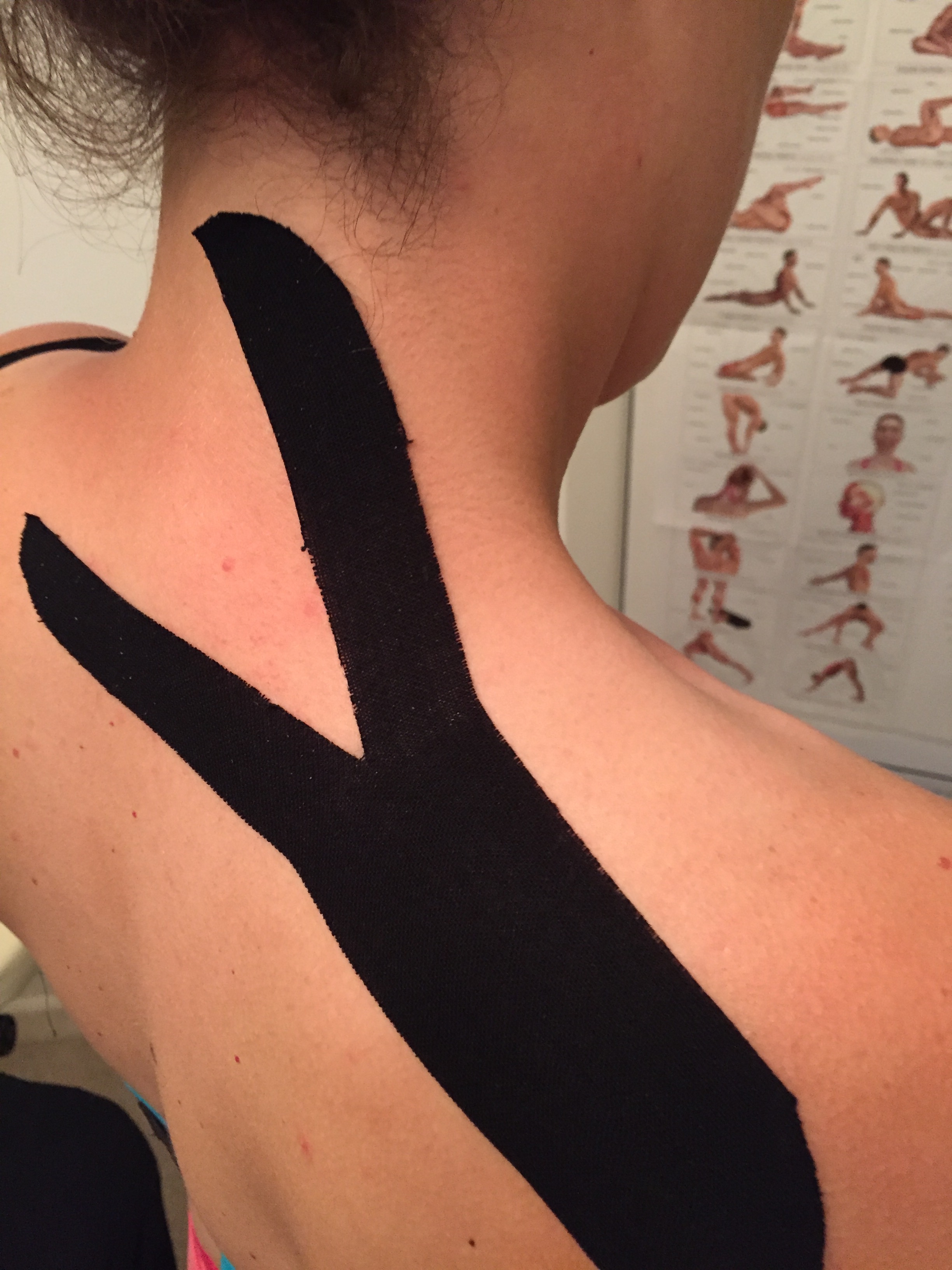Black kinesio tape in a Y shape up the back of a neck and across one trapezius