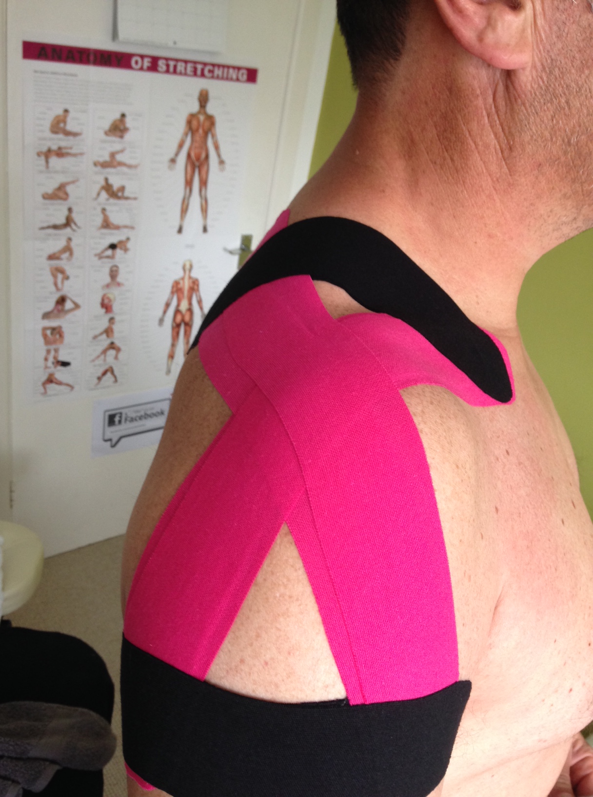 Bright pink and black kinesio tape across a shoulder and neck in Claire's treatment room
